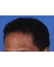 After Hair Transplant&nbsp;Front